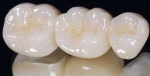 Consultorio Medico Odontologico Dra Odontologa Silvina Crisi Coronas de Zirconio Carillas Dentales